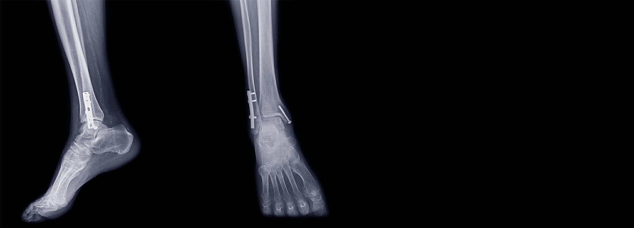 X-ray of feet with medical implants and screws