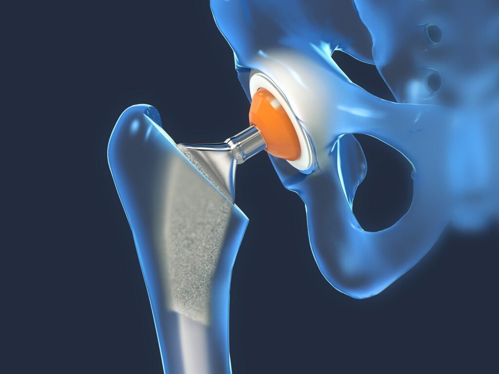 3D rendering of a total hip replacement device in a model skeleton