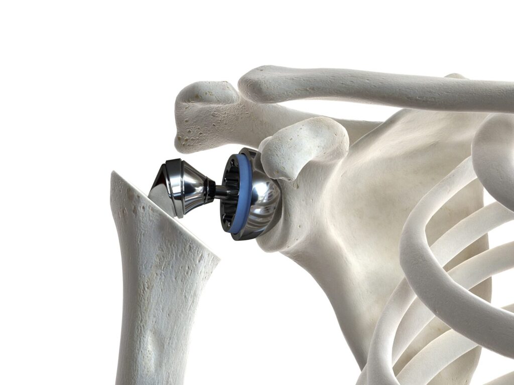 3D rendering of a shoulder replacement device in a skeleton