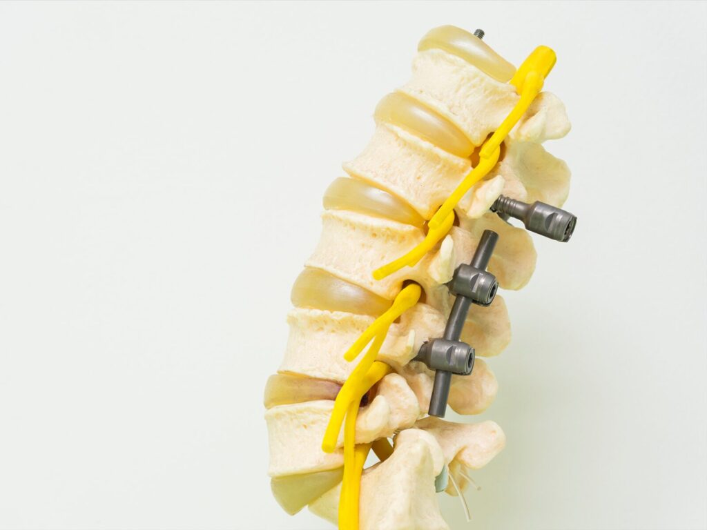 Side view of spinal rods and screws embedded in a model lumbar spine