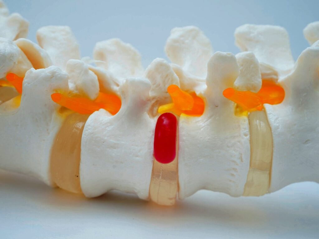 Model spine with hernia between lumbar joints