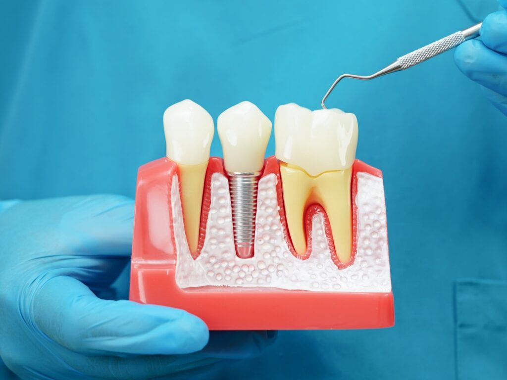 dental implant