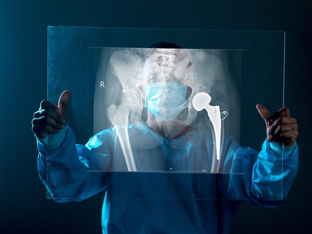 Doctor Looking at X-ray Scan of Hip Implant