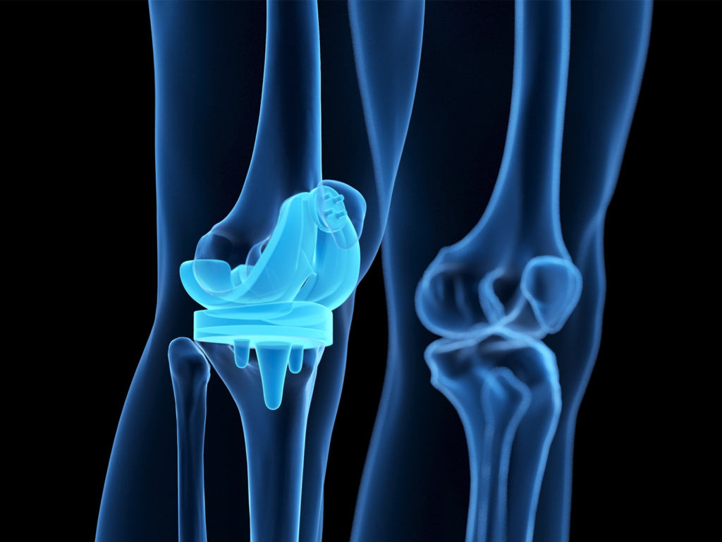 Metallic Implant